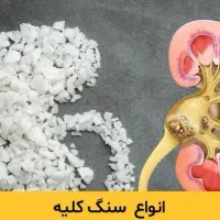 سنگ کلیه|خوردنی و آشامیدنی|مهاباد (آذربایجان غربی), |دیوار