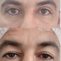 بلفاروپلاستی/ جراحی پلک / لیفت ابرو/ سانترال لب|خدمات آرایشگری و زیبایی|تهران, صادقیه|دیوار