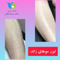 لیزر موهای زائد بانوان الکساندرایت نابلکس شاتی|خدمات آرایشگری و زیبایی|قزوین, |دیوار