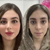 مزونیدلینگ ژل و بوتاکس