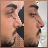اصلاح فرم و کوچک کردن بینی توسط پزشک بدون جراحی|خدمات آرایشگری و زیبایی|قم, دورشهر|دیوار