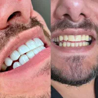 خدمات کامپوزیت دندان با اقساط آسان|خدمات آرایشگری و زیبایی|قم, صفائیه|دیوار