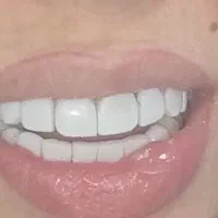 تخفیفات ویژه کامپوزیت در درمانگاه تخصصی یاسوج|خدمات آرایشگری و زیبایی|یاسوج, |دیوار