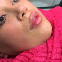 ژل و بوتاکس