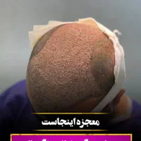 کاشت مو با جدید ترین تکنیک|خدمات آرایشگری و زیبایی|دزفول, |دیوار