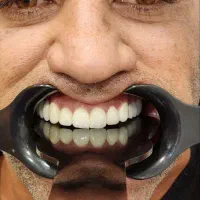 عصب کشی،ترمیم،روکش،لیفت لثه،جرم گیری و بلیچینگ|خدمات آرایشگری و زیبایی|شیراز, قصرالدشت|دیوار
