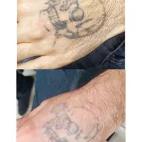 پاک کردن تتو با لیزر کیوسوییچ تضمینی|خدمات آرایشگری و زیبایی|تهران, نیروی هوایی (پیروزی)|دیوار