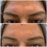 تزریق فیلر (ژل) بوتاکس مزو  در کلینیک ونوس با قی|خدمات آرایشگری و زیبایی|تهران, حر|دیوار