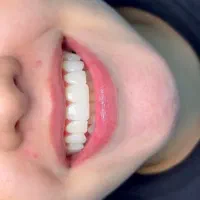 جشنواره‌ی بزرگ کامپوزیت دندان|خدمات آرایشگری و زیبایی|یاسوج, |دیوار