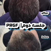 مرکز پی آر پی ،مزوتراپی ،سلول درمانی ،زانو،بوتاکس