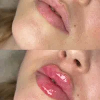 ژل و بوتاکس