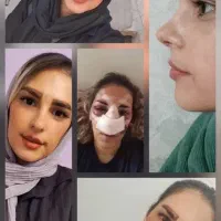 عمل زیبایی بینی در مازندران|خدمات آرایشگری و زیبایی|قائمشهر, |دیوار