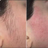 الکترولیز|خدمات آرایشگری و زیبایی|شیراز, میانرود|دیوار