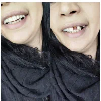 جشنواره دندان مصنوعی خارجی ژله ای با بیمه وضمانت|خدمات آرایشگری و زیبایی|کرج, مصباح|دیوار