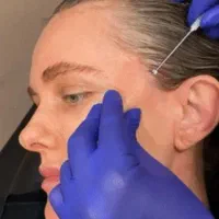 بوتاکس ژل مزوتراپی مو و صورت میکرونیدلینگ فشیال|خدمات آرایشگری و زیبایی|چهارباغ, |دیوار