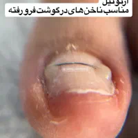 خدمات ارتونیل(ارتودنسی ناخن)وکفسابی ،درمان میخچه|خدمات آرایشگری و زیبایی|تهران, دردشت|دیوار