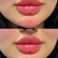 فیلر لب کُره ای فقط ۳تومن