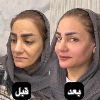 آموزش و تزریق ژل فیلر و بوتاکس توسط پزشک