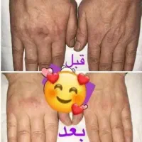 کرم معجزه اصل ضد لک و جوش سفید شدن پوست ضمانتی|آرایشی، بهداشتی، درمانی|لردگان, |دیوار