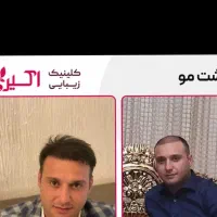 کاشت مو ابرو ریش کلینیک تخصصی اکسیر اقساطی|خدمات زیبایی و سلامت|تبریز, |دیوار