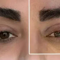 بلفاروپلاستی باروش لیزری و عمل های زیبایی