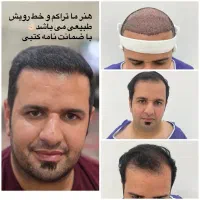 کاشت مو یا معجزه.محیط VIP،تیم شیراز در یزد(تضمینی)|خدمات آرایشگری و زیبایی|یزد, |دیوار