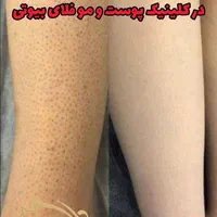 لیزر موهای زاید روشن سازی پاک کردن تتو دردرمانگاه|خدمات آرایشگری و زیبایی|شیراز, حافظیه|دیوار