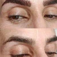 فیبروز ومیکرو بلیدینگ وشیدینگ لب