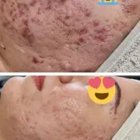 فیشال تخصصی پاکسازی تخصصی پوست با دستگاه