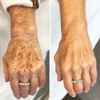 بیوممتیک اورجینال شارژ شد