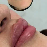 خدمات ژل بوتاکس