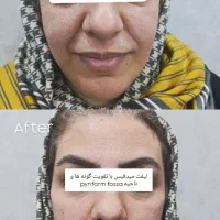 کانتورینگ و زاویه سازی،ژل لب و بوتاکس کاملا اقساطی|خدمات آرایشگری و زیبایی|قم, بکایی|دیوار