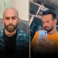 کاشت مو و ابرو حرفه ای و تخصصی،در بهترین کلینیک