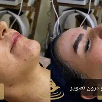فشیال پوست وپلاژن تراپی درکلینیک با دستگاه|خدمات آرایشگری و زیبایی|کرج, کوی زنبق|دیوار