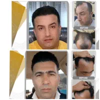 لیزیک چشم /لیپوماتیک /آبدومینو/ کاشت مو/بلفارو|خدمات آرایشگری و زیبایی|کرمانشاه, |دیوار