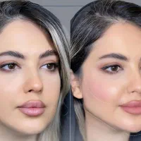 تخفیف ویژه ژل،بوتاکس،هایفو،بلفارو،انواع لیفت صورت