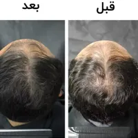 درمان قطعی ریزش مو|آرایشی، بهداشتی، درمانی|رشت, کوی جام جم|دیوار