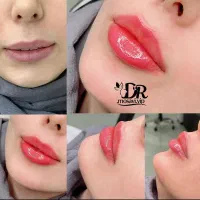 جشنواره تحول زیبایی ژل.بوتاکس.لیزر.مزو.توسط پزشک|خدمات آرایشگری و زیبایی|قم, زنبیل آباد|دیوار