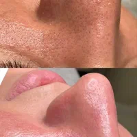 پاکسازی صورت مطب دکتر آذین اسکندری