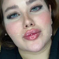 کلینیک تخصصی تزریق فیلر/ژل لب روسی/مادلینگ نچرال|خدمات آرایشگری و زیبایی|تهران, الهیه|دیوار