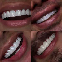 کامپوزیت ارزان اقساطی لمینیت ایمپلنت