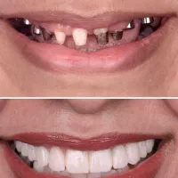 ایمپلنت کره 13.9/اقساطی بدون کارمزد