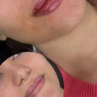 فیلرژل لب بوتاکس فیلر مادلینگ لیزرموهای زائدفشیال|خدمات زیبایی و سلامت|تهران, نیروی هوایی (پیروزی)|دیوار