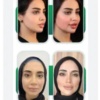 مدل تعداد محدود جهت تزریق لب روسی و کانتورینگ صورت|خدمات آرایشگری و زیبایی|تهران, زعفرانیه|دیوار