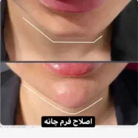 تخفیف ویژه تزریق فیلروبوتاکس باماندگاری بالا|خدمات آرایشگری و زیبایی|فلاورجان, |دیوار