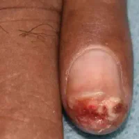 دیابت