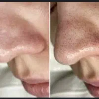 اموزش وخدمات تخصصی پوست باتخفیف بلک فرایدی|خدمات آرایشگری و زیبایی|تربت جام, تیپ ۳۸ زرهی تربت جام|دیوار