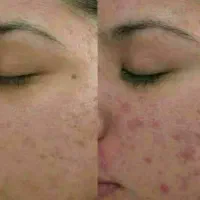 درمان بیماری هاباطب سنتی واصلاح مزاج|خدمات آرایشگری و زیبایی|بروجن, |دیوار
