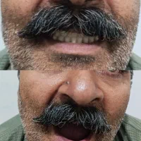 دندان مصنوعی|خدمات آرایشگری و زیبایی|آبیک, |دیوار