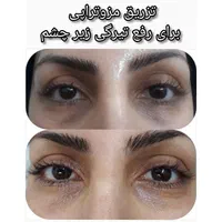ژل بوتاکس ۳۹۰/ فیلربینی زیرچشم/لیفت صورت شقیقه/نخ|خدمات آرایشگری و زیبایی|تهران, فدک|دیوار